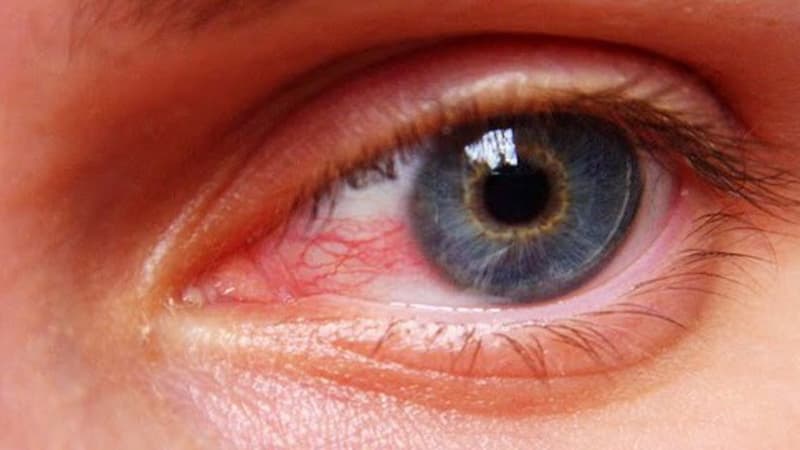 Tensão ocular