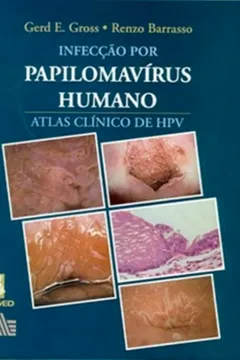 Livro Infecção por Papilomavírus Humano - Resumo, Resenha, PDF, etc.